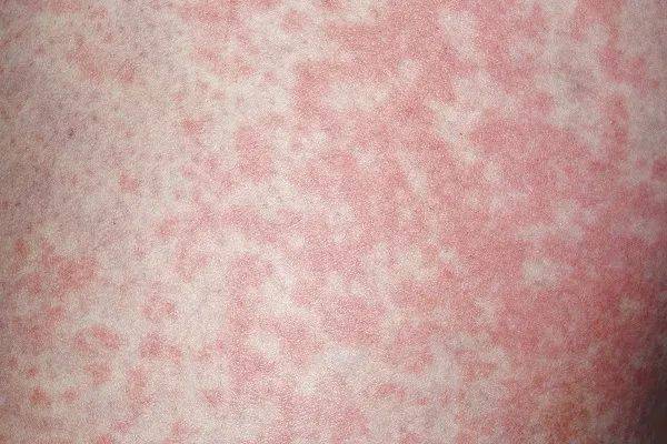 內衣襪子混洗，男子確診感染！醫生: 這三件事要特別注意→